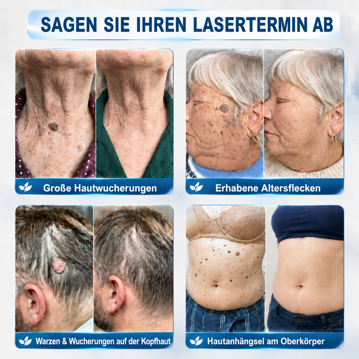 HISKIN® 🧑‍⚕️ 7-Tage- Hautanhängsel- & Fleckenentferner – Fortschrittlicher Roll-on-Stift zur schmerzfreien und narbenfreien Entfernung von Hautunreinheiten