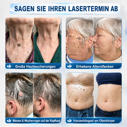 HISKIN® 🧑‍⚕️ 7-Tage- Hautanhängsel- & Fleckenentferner – Fortschrittlicher Roll-on-Stift zur schmerzfreien und narbenfreien Entfernung von Hautunreinheiten