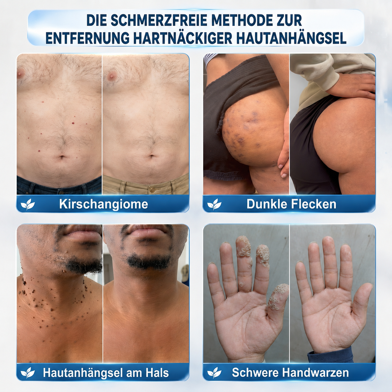 HISKIN® 🧑‍⚕️ 7-Tage- Hautanhängsel- & Fleckenentferner – Fortschrittlicher Roll-on-Stift zur schmerzfreien und narbenfreien Entfernung von Hautunreinheiten