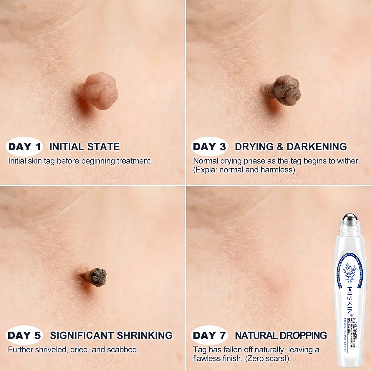 HISKIN® 🧑‍⚕️ 7-Tage- Hautanhängsel- & Fleckenentferner – Fortschrittlicher Roll-on-Stift zur schmerzfreien und narbenfreien Entfernung von Hautunreinheiten